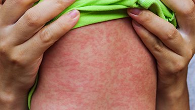 Confirmed infant Measles case