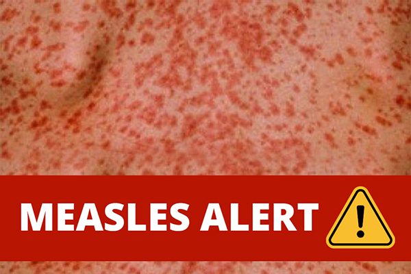 Measles Alert feature image