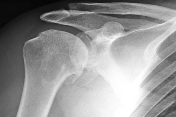 Shoulder X-Ray: A world-first study is investigating the best approach to shoulder joint replacement surgery for the treatment of osteoarthritis of the shoulder.