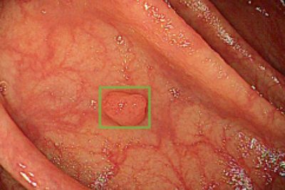 AI identifies areas of interest in a colonoscopy