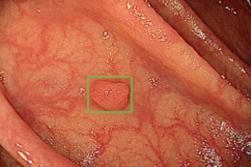 AI identifies areas of interest in a colonoscopy