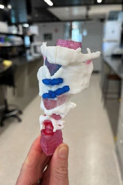 3D printed model assisting with surgery