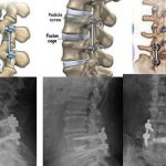 New UQ and Metro North study comparing treatments for persistent severe low back pain