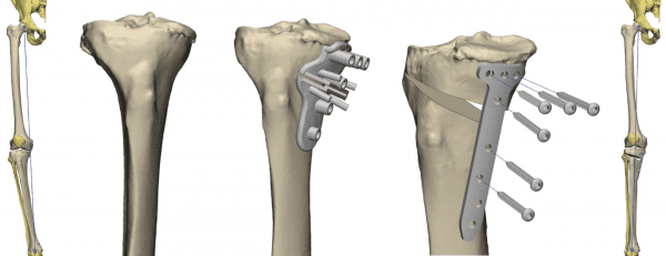 bone with cutting guide example